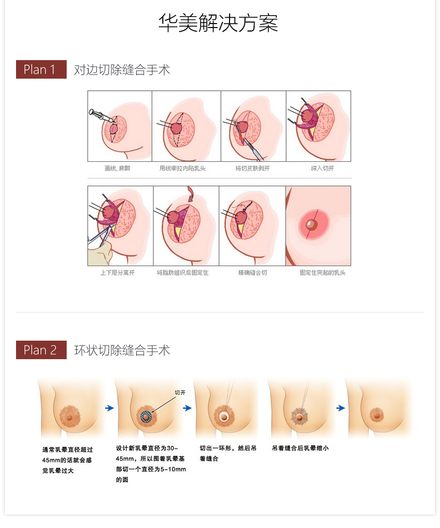 上海乳晕缩小哪家医院好-乳晕缩小多少钱 - 上海华美